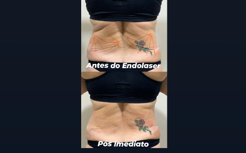 Endolaser/Endolift