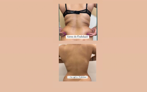 Endolaser/Endolift