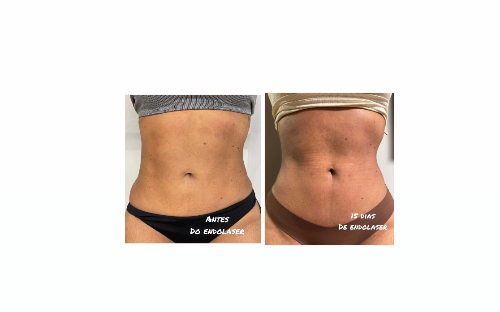 Endolaser/Endolift