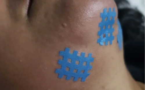 Kinesio tape