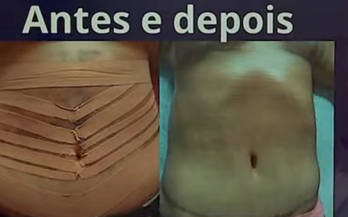 10 sessões pós cirúrgico