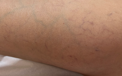 Aplicação em microvasos