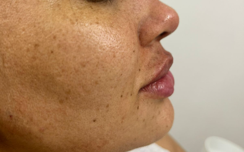 Preenchimento labial