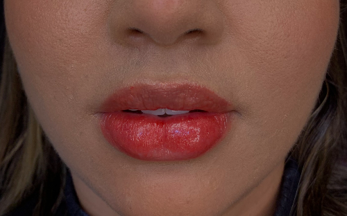 Preenchimento labial