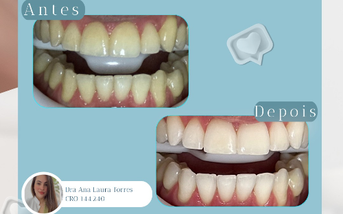 Clareamento Dental