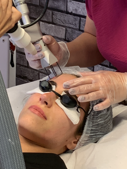 Laser CO2 Fracionado