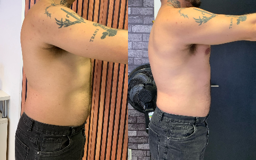 Aplicação de Enzimas para Gordura Localizada