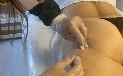 Bioestimulador de Glúteos