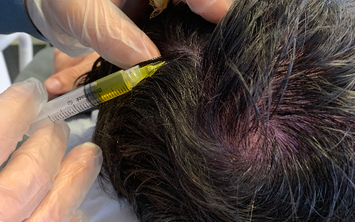 Terapia Capilar - Protocolo