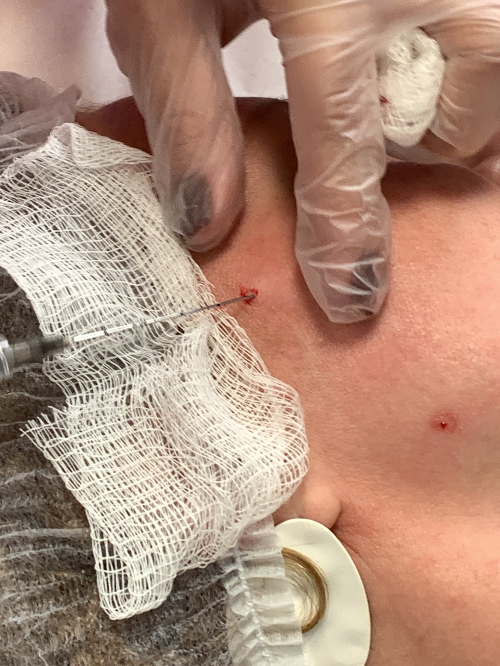 Bioestimulador de colágeno Radiesse