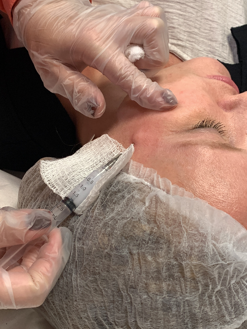 Bioestimulador de Colágeno Renova