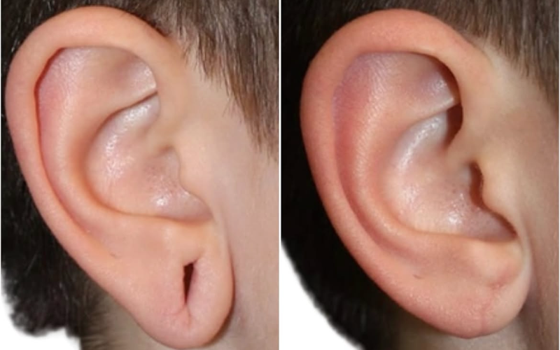 Labuloplastia com Jato