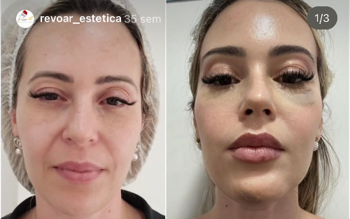 Bioestimulador de colágeno Face
