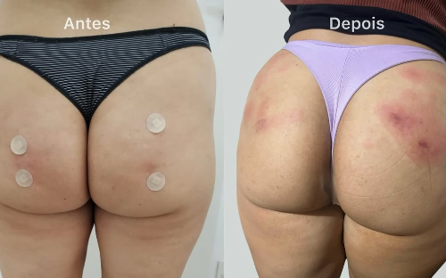 Bioestimulador de colágeno Corporal