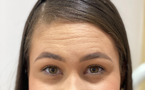 Toxina botulínica (botox)