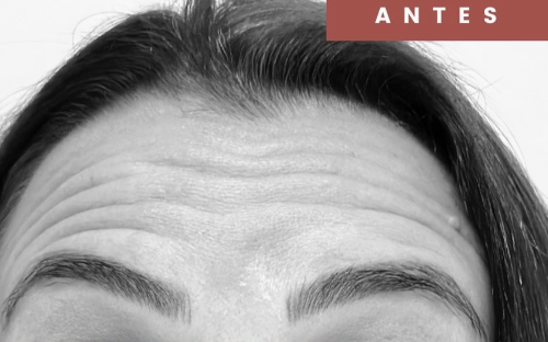 Botox