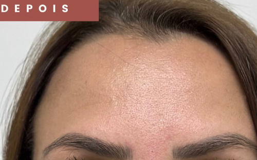 Botox