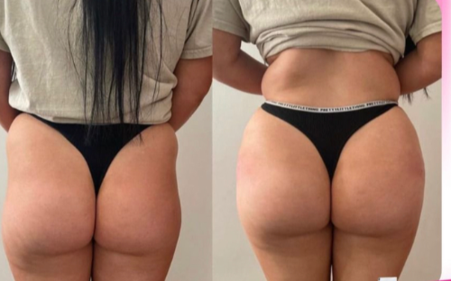 Bioestimulador de Glúteos