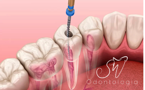 Tratamento de Canal (endodontia)