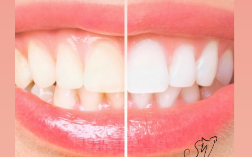 Clareamento dentário