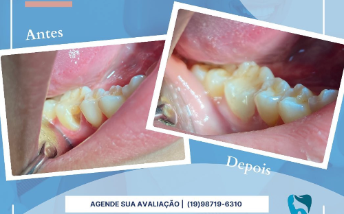 Restauração em resina composta