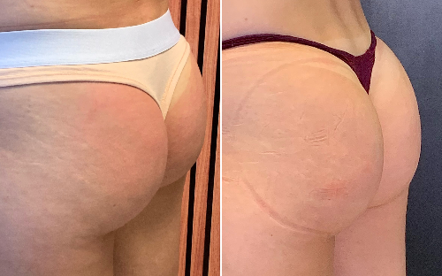 Pump up - Procedimento Glúteos