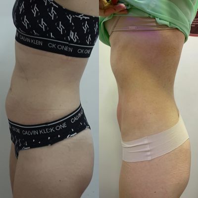 Hidrolipoclasia Hidrohot