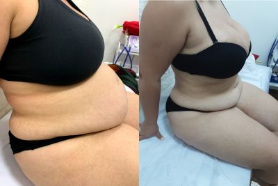 Harmonização Corporal Feminina