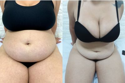 Harmonização Corporal Feminina