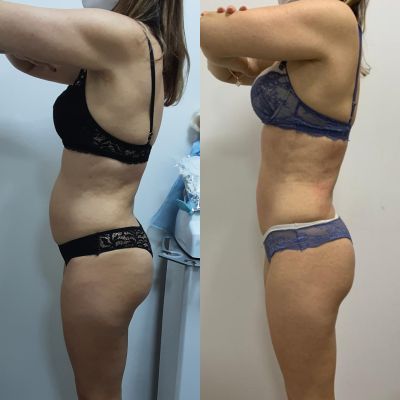 Harmonização Corporal Feminina