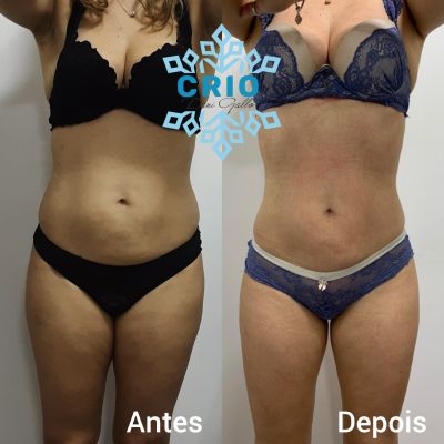 Harmonização Corporal Feminina