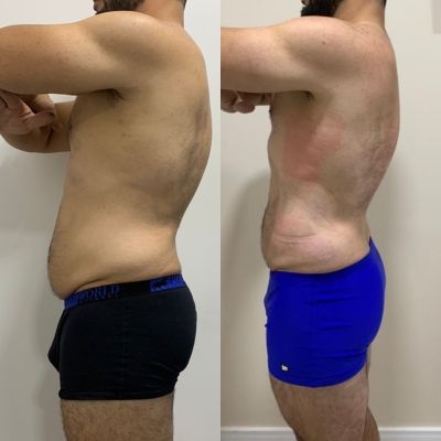 Harmonização Corporal Masculina