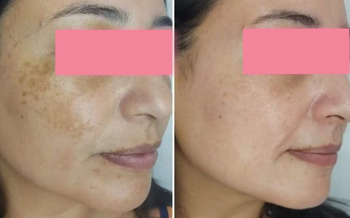 Magic Melasma Control
