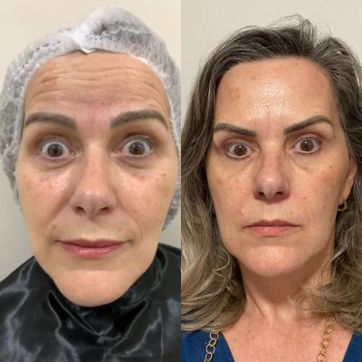 Botox