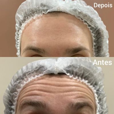 Botox