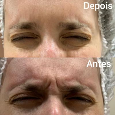Botox