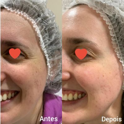 Botox