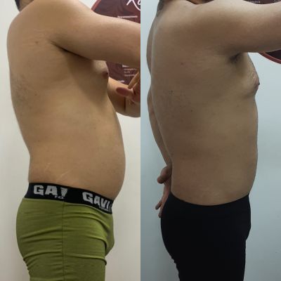 Harmonização Corporal Masculina