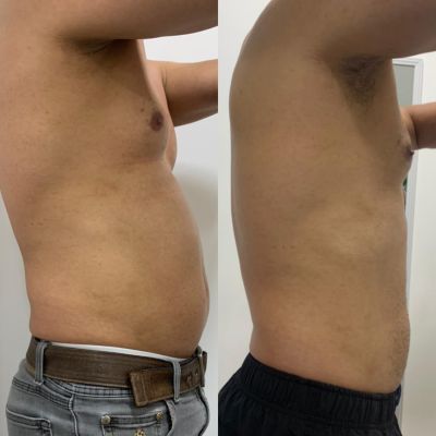 Hidrolipoclasia Hidrohot