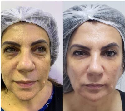 Preenchimento FACIAL