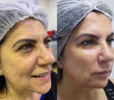 Preenchimento FACIAL