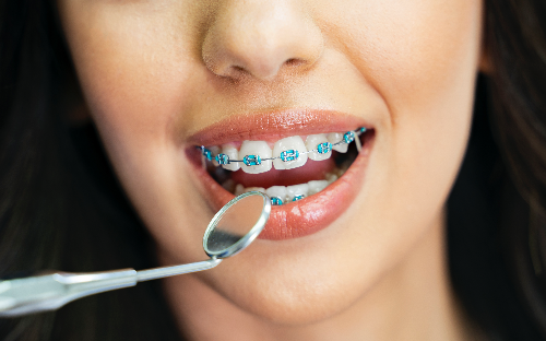 APARELHO ORTODÔNTICO