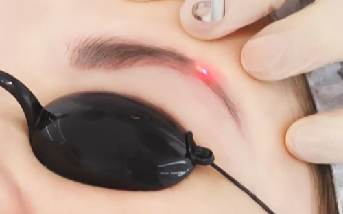 Remoção de Micropigmentação