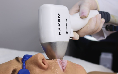 Depilação a Laser
