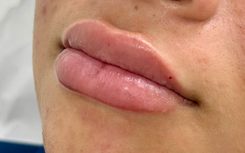 Preenchimento Labial
