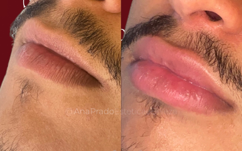 Preenchimento Labial