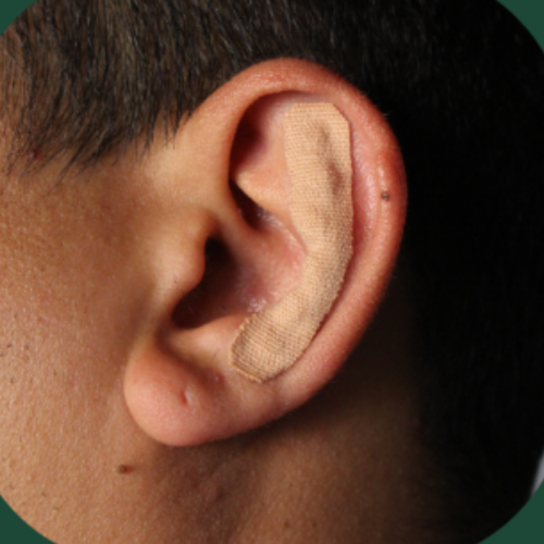 BANDAGEM AURICULAR + MASSAGEM AURICULAR
