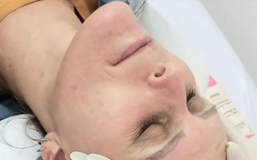 Hidratação Hyaluface face
