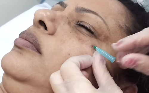 Fio Filler