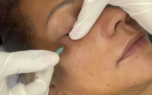 Fio Filler